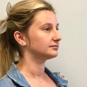 Young woman nose job with bone and nasal tip custom Rhinoplasty pre operative side view – pre op oblique blonde